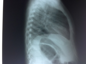 X-ray of patient in ED - can you spot the pneumonia?
